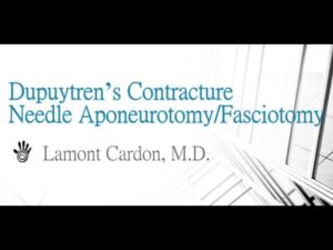 Dupuytren's Contracture Needle Aponeurotomy/Fasciotomy