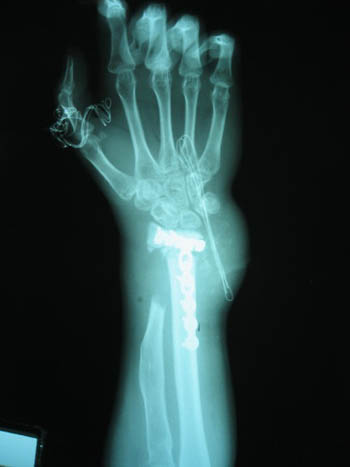 X-Ray